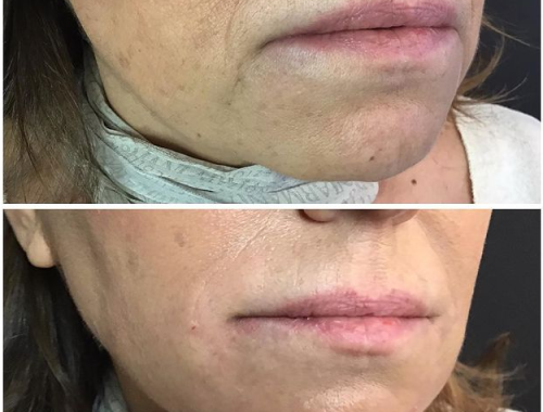 fili-di-trazione-prima-e-dopo